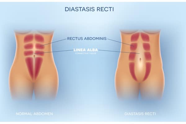 What Non-Surgical Options Are Available for Diastasis Recti Canterbury?