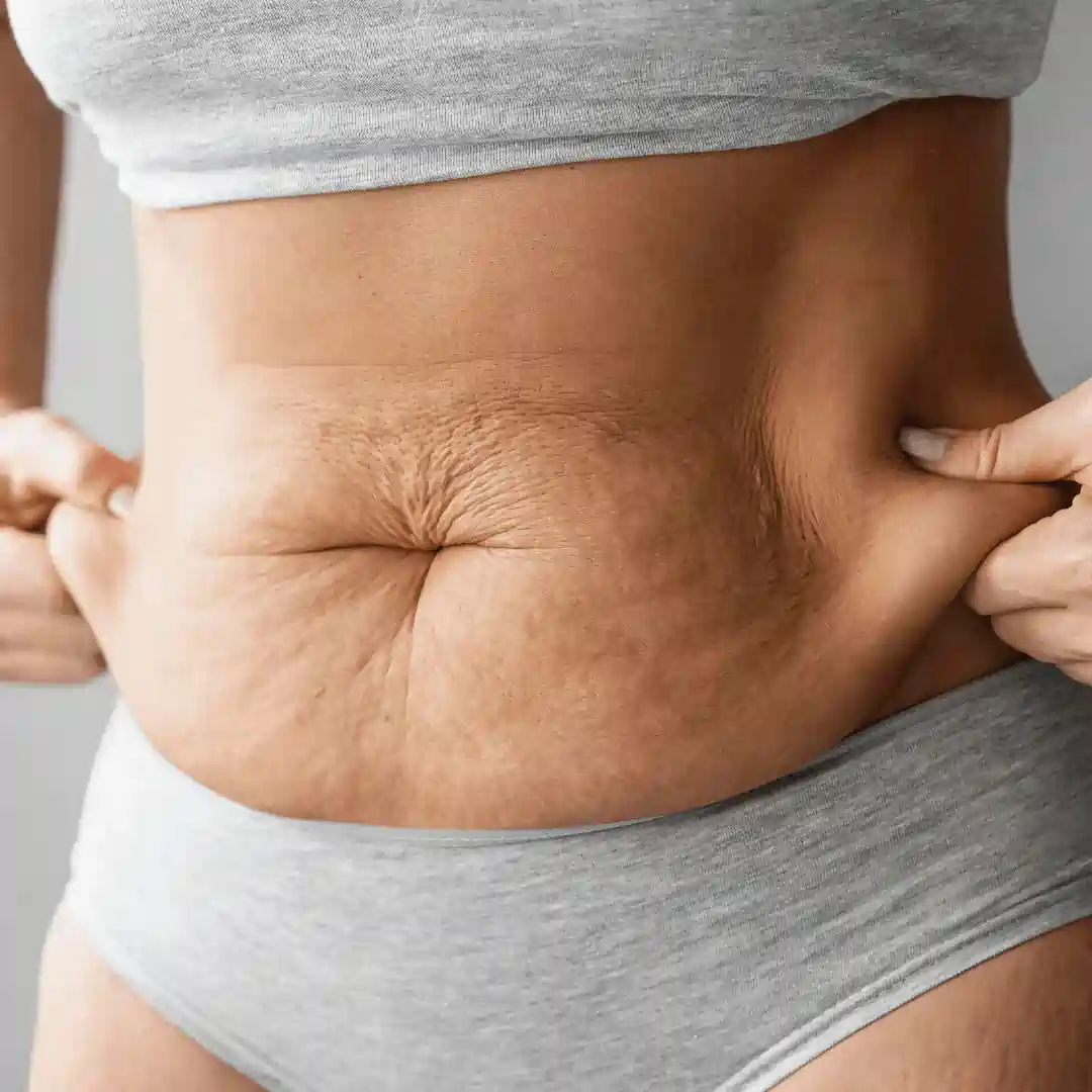 Is It Normal to Have Loose Skin After Pregnancy Canterbury?