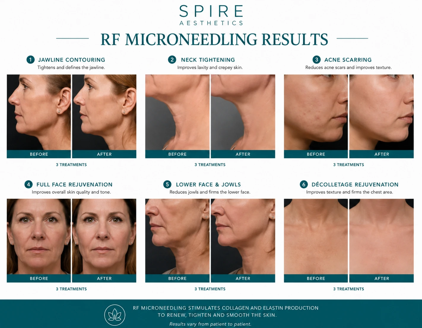 RF Microneedling Skin tightening Canterbury results