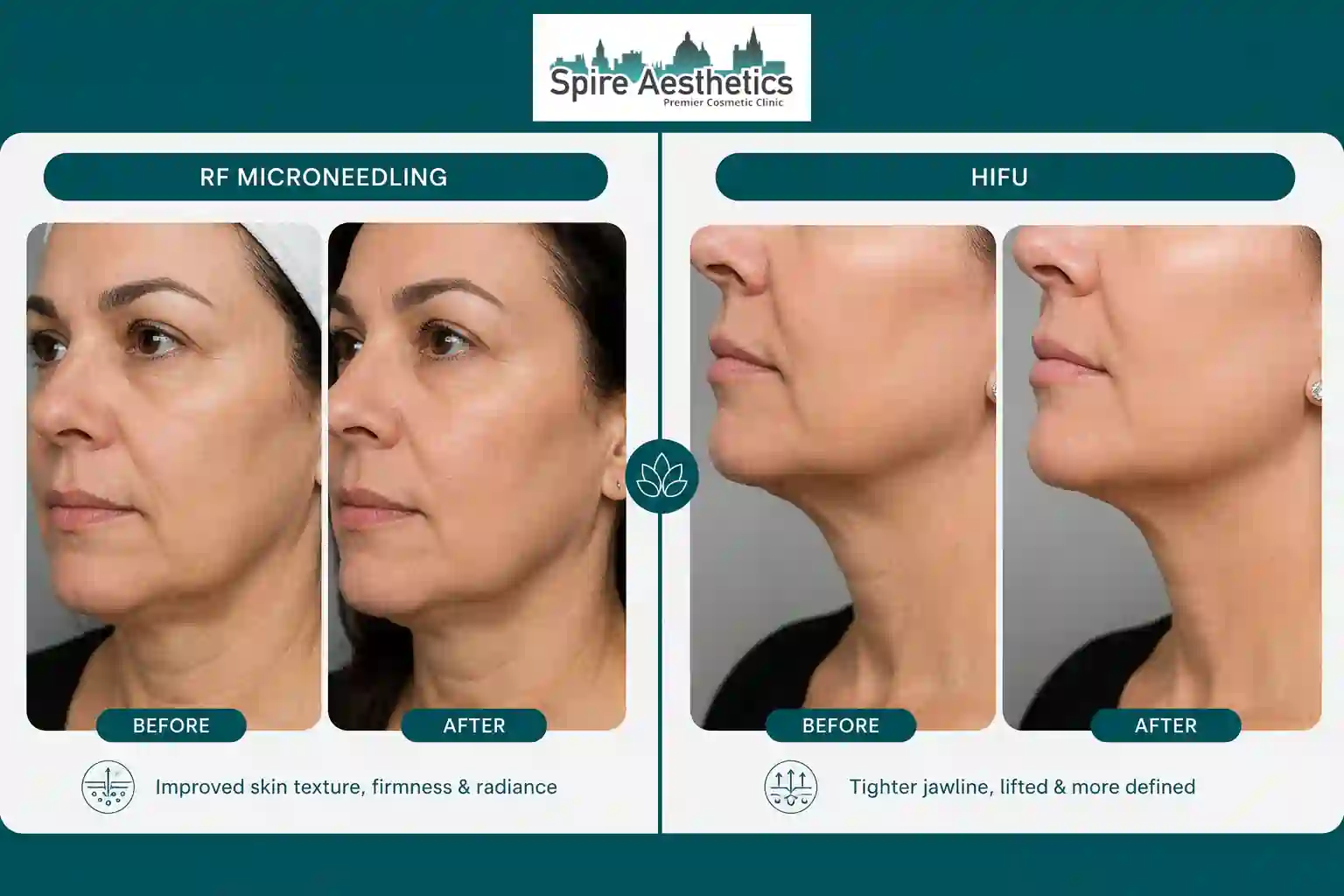 Can RF Microneedling and HIFU Be Combined Canterbury?