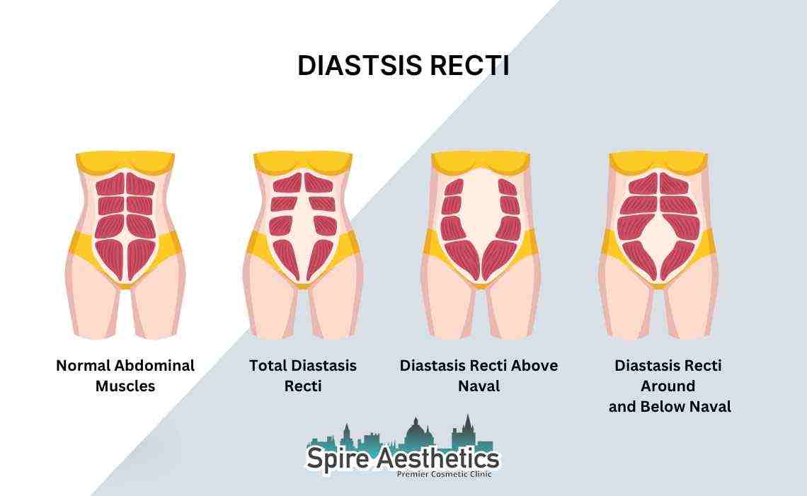 Is Non-Surgical Diastasis Recti Treatment Right for You? Common Concerns Answered Canterbury